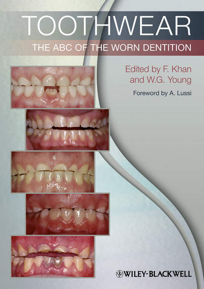 Toothwear. The ABC of the Worn Dentition