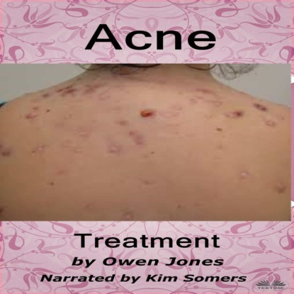 Acne Treatment