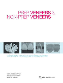Prep Veneers und Non-Prep Veneers