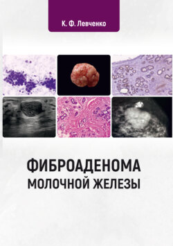 Фиброаденома молочной железы