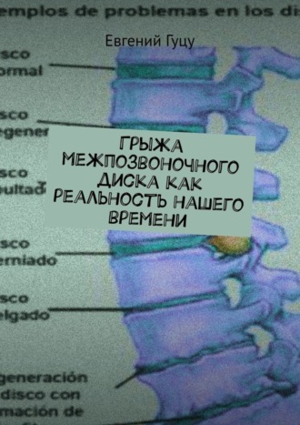 Грыжа межпозвоночного диска как реальность нашего времени